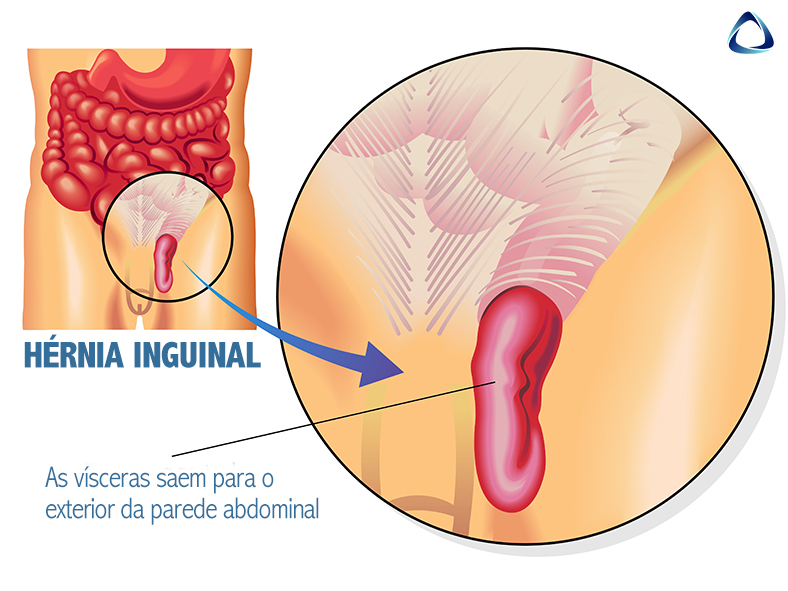 hernia inguinal 