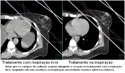 radioretapia-no-tratamento-do-cancer-neoplasia-de-mama