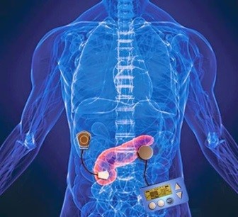 Ilustração mostrando o Pâncreas artificial